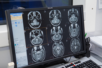 MRI of the cerebral vessels