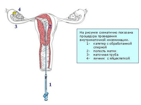 Внутриматочная инсеминация (ВМИ) – это введение обработанной спермы в полость матки вне полового акта