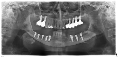 Мобилизован лоскут. Наложены швы профимед. Аппликация Solcoseril Dental