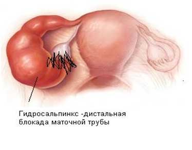 Дистальная трубная патология включает в себя гидросальпинкс и фимбриальный стеноз.
